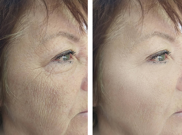 обличчя літньої жінки до і після лікування
 - Фото, зображення