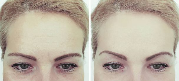 női homlok ráncok a kezelés előtt és után - Fotó, kép