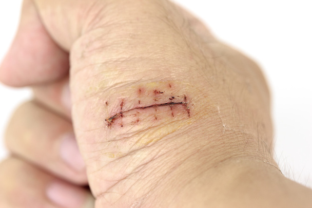 Primo piano di una ferita alla mano con punti
 - Foto, immagini
