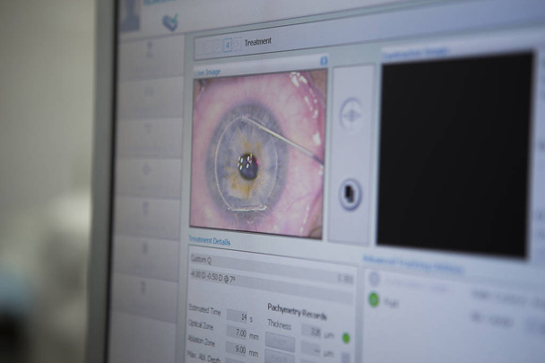 Chirurgii laserowej korekcji wzroku - Zdjęcie, obraz