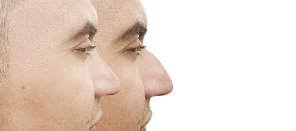 männlicher Nasenhöcker vor und nach der Behandlung - Foto, Bild