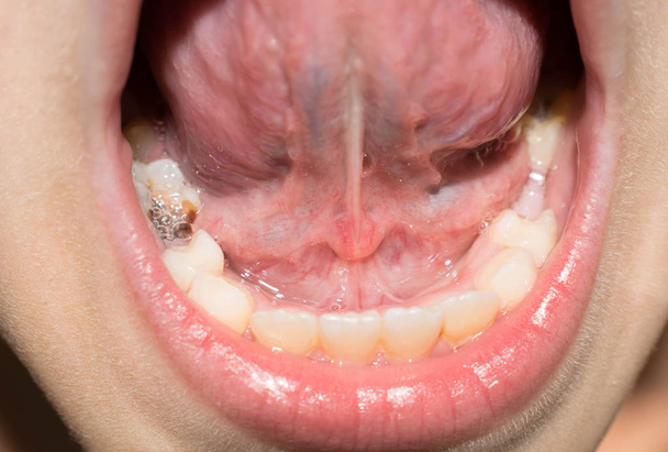 Denti da latte primari cadere pausa annerire infettato da carie per la medicina
 - Foto, immagini