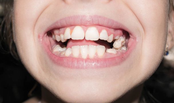 Dentes de leite primários cair quebrar enegrecer infectado com cárie para a medicina
 - Foto, Imagem