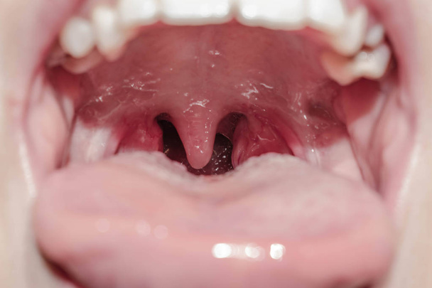 喉頭咽喉腺舌ウイルス性言語炎症薬用扁桃口の炎症 - 写真・画像
