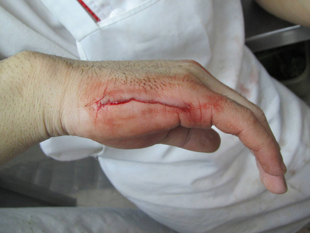 Травма руки
 - Фото, изображение
