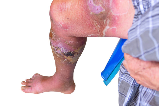Erysipel bakterielle Infektion unter der Haut Bein gealterten Menschen auf weißem Hintergrund - Foto, Bild
