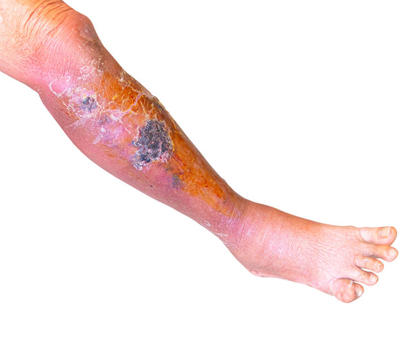 紅斑細菌感染 皮膚脚の下で高齢者 白い背景に - 写真・画像