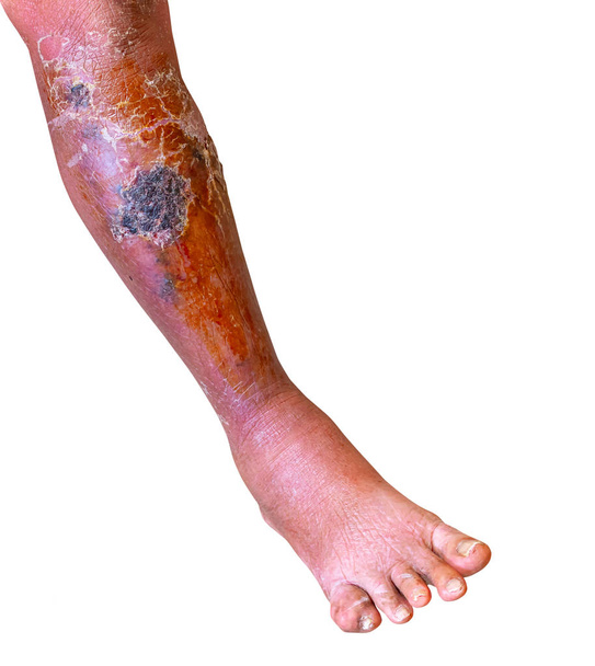 Erizipelas bakteriyel enfeksiyon Deri bacak altında beyaz arka planda yaşlı insanlar - Fotoğraf, Görsel