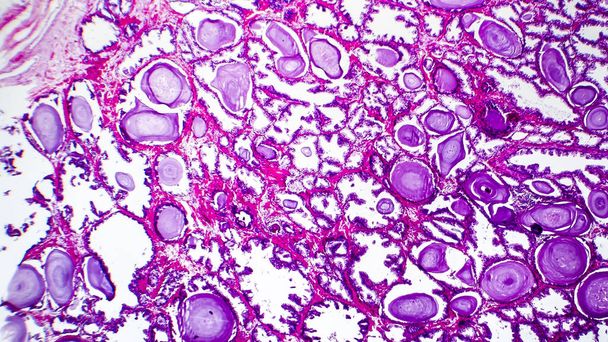 Histopatologia da hiperplasia da próstata
 - Foto, Imagem