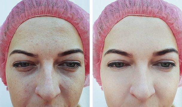 Kadın gözü tedaviden önce ve sonra kırışıyor. - Fotoğraf, Görsel
