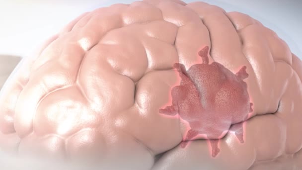 Rosszindulatú daganat az idegrendszer glia szöveteiben. - Felvétel, videó
