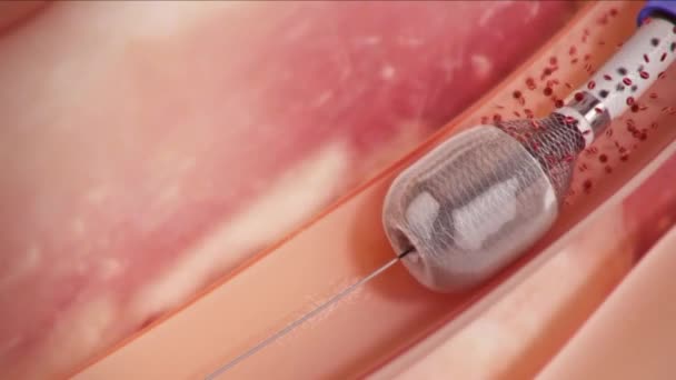 Angioplastia con balón procedimiento mínimamente invasivo
 - Metraje, vídeo
