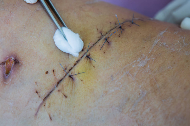 sutura di operazione con una fibra blu a paziente di gamba
 - Foto, immagini