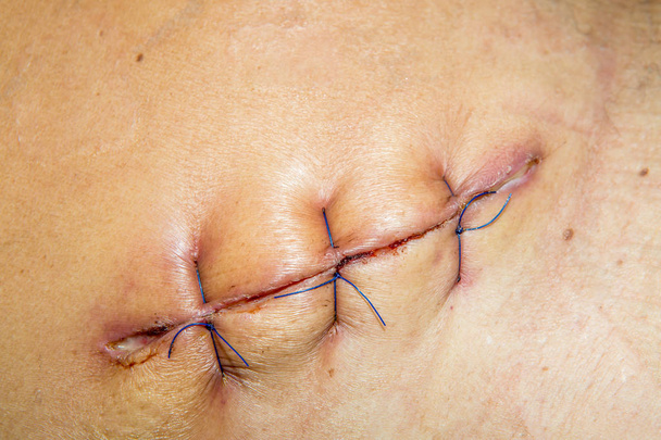 cicatriz da sutura de operação com uma fibra azul
 - Foto, Imagem