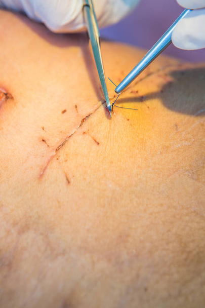 suture d'opération avec une fibre bleue au patient de la jambe
 - Photo, image