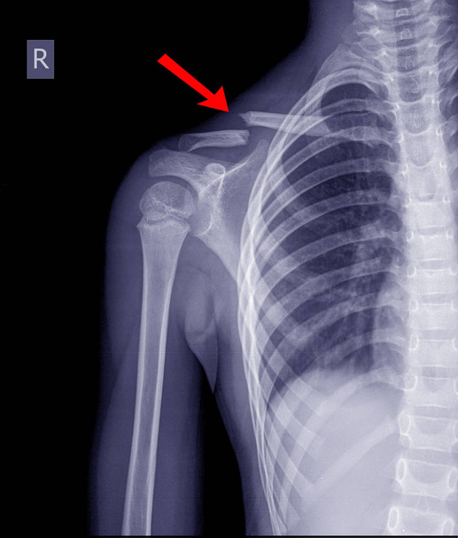 Fracture par radiographie thoracique clavicule droite
. - Photo, image