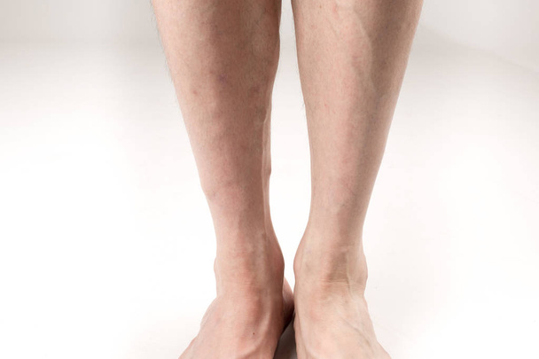 naked legs of a man with varicose veins on a white background - Foto, Bild
