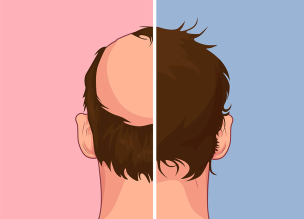 Выпадение волос. Этапы алопеции человека проблема векторной медицинской иллюстрации здоровья До после
 - Вектор,изображение