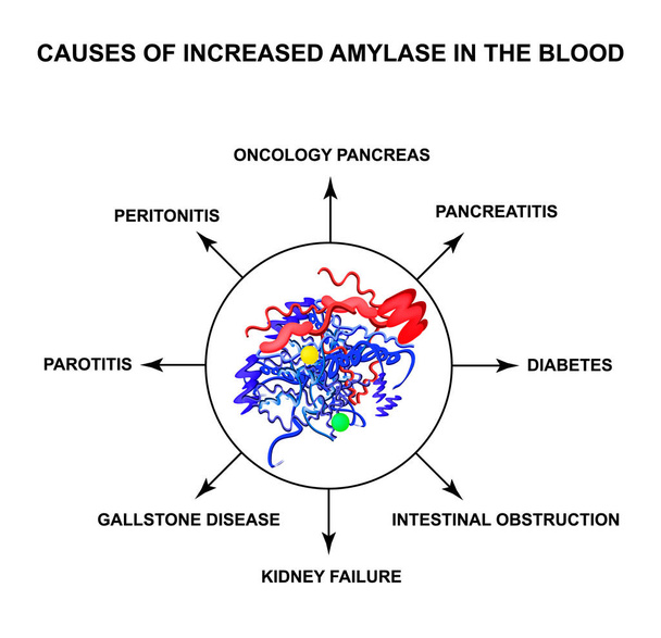 Causas de aumento de la amilasa en la sangre. La enzima amilasa. Infografías. Ilustración vectorial sobre fondo aislado
 - Vector, Imagen