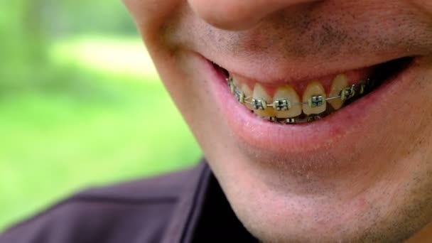 Suportes para dentes amarelados. Close-up de um tipo sorridente. Os dentes de uma pessoa fumante. Conceito dentário. Profundidade de campo rasa
. - Filmagem, Vídeo