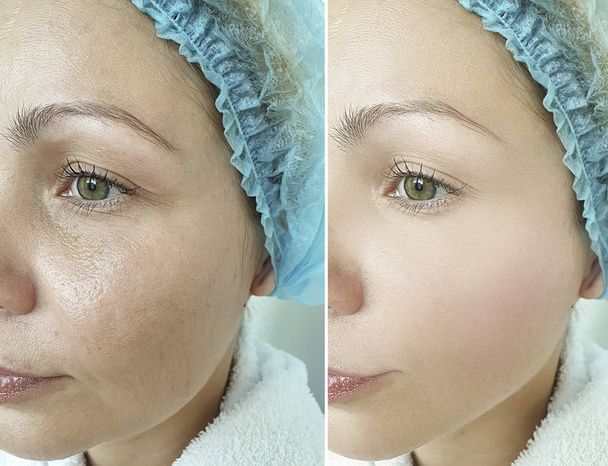 woman wrinkles face before and after treatments - Photo, Image