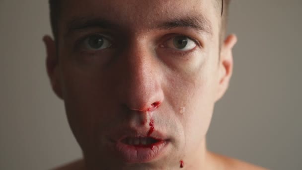 Zbliżenie człowieka prawdziwe krwawienie z nosa. - Materiał filmowy, wideo