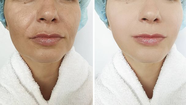 γυναίκα, πρόσωπο ρυτίδες πριν και μετά από διαδικασίες - Φωτογραφία, εικόνα