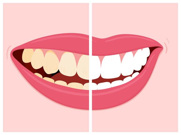 Antes y después de la vista de blanqueamiento de dientes
 - Vector, imagen