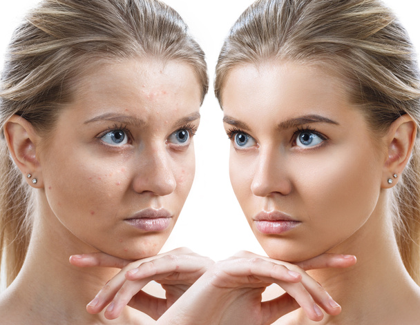 Mulher jovem antes e depois do tratamento da pele e maquiagem
. - Foto, Imagem