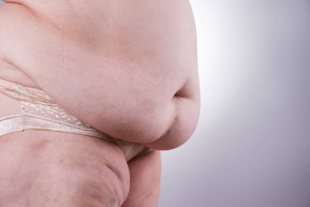 Tummy tuck, flabby skin on a fat belly, plastic surgery concept - Foto, imagen