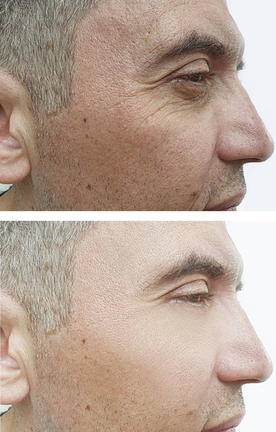 férfi szeme ráncok a kezelés előtt és után - Fotó, kép