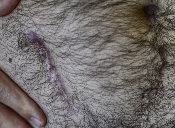 Белый мужчина показывает свой шрам после операции по удалению
 - Фото, изображение