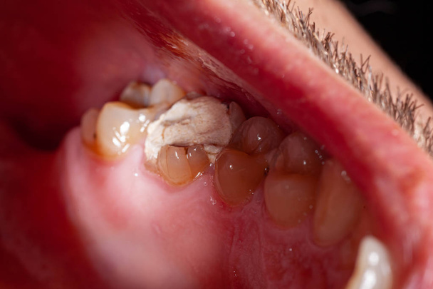 hammaskarieksen tilapäinen täyttäminen potilas
 - Valokuva, kuva
