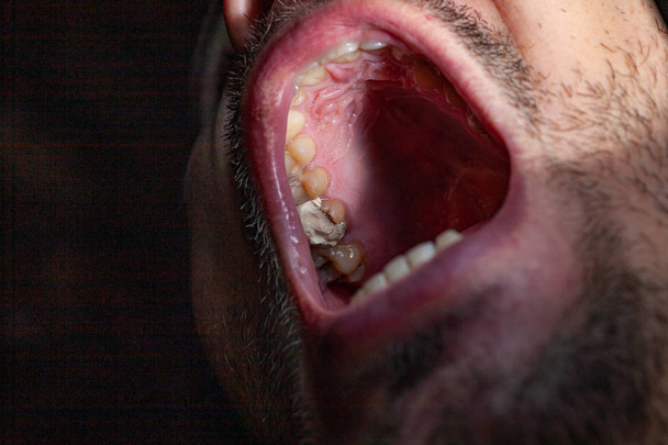 временное наполнение зуба пациента кариеса
 - Фото, изображение