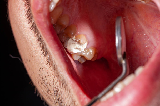 Remplissage temporaire d'un patient atteint de carie dentaire
 - Photo, image