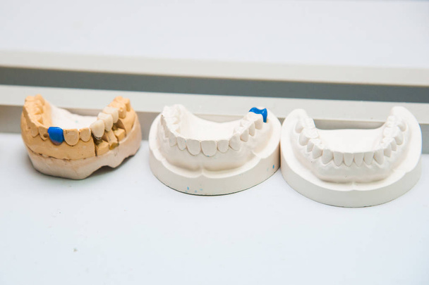 Zubař je zubní implantát protézy vyrobené ze sádry - Fotografie, Obrázek