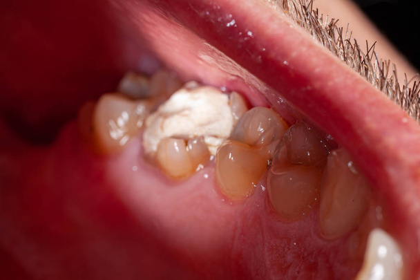 Relleno temporal de un paciente con caries dental
 - Foto, Imagen