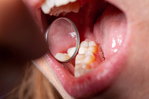 тимчасове заповнення зуба карієсом пацієнта
 - Фото, зображення