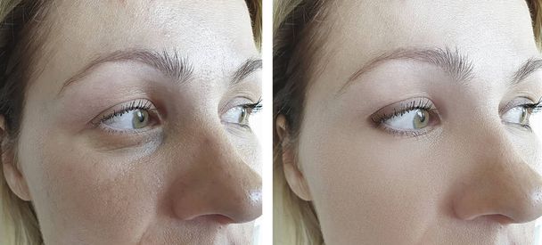 femme visage rides avant et après le traitement - Photo, image