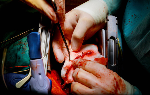Cirurgia para doença arterial coronariana usando a técnica sem CEC
 - Foto, Imagem