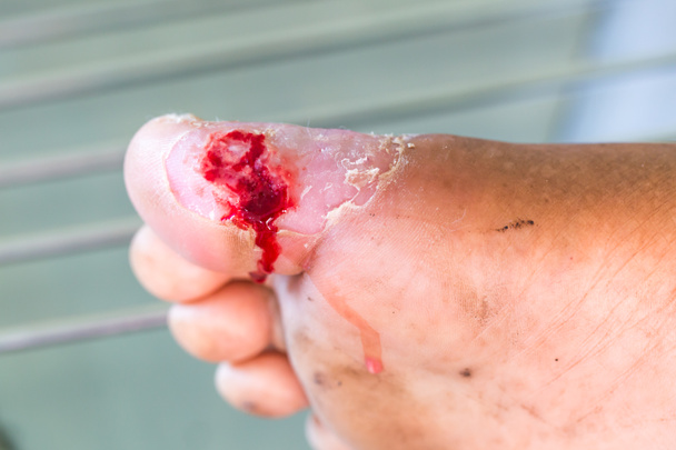 ferita infetta del piede diabetico
 - Foto, immagini