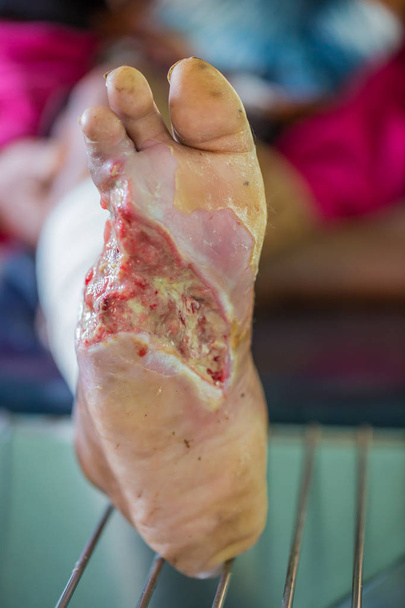 diyabetik ayak yarası - Fotoğraf, Görsel