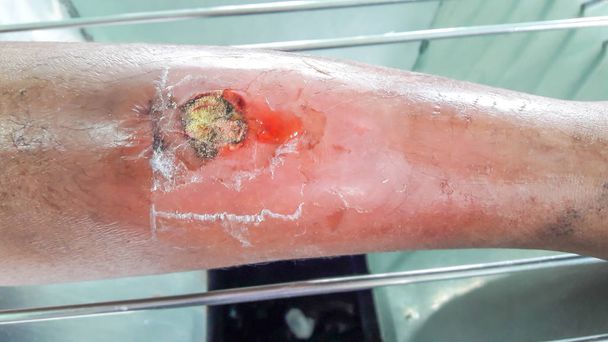 ferida infectada da perna
 - Foto, Imagem