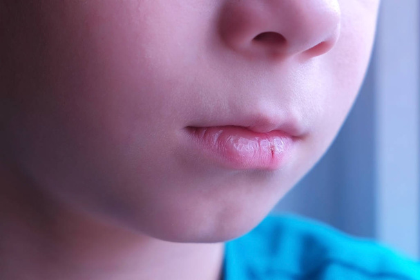 Child boy with cracked dry lip, mouth closeup. - Fotoğraf, Görsel