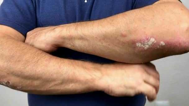 乾癬と湿疹を持つ老人の指。皮膚剥離のクローズアップ - 映像、動画