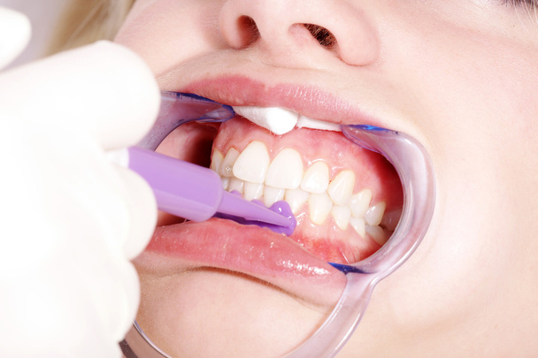 Cosmetic dental cleaning - Φωτογραφία, εικόνα