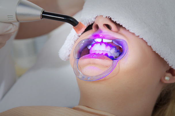 Cosmetic dental cleaning - Foto, afbeelding