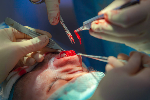 Surgeon and his assistant performing cosmetic surgery on nose in hospital operating room. Nose reshaping, augmentation. Rhinoplasty. - Foto, Bild