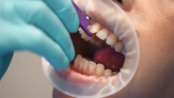 Kadın Diş Hekimi Instaling Braces Hastaya, Close Up. Yavaş Hareket Efekti - Video, Çekim