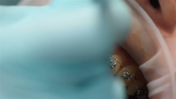 Ο οδοντίατρος φτιάχνει τσίχλα σε σιδεράκια στην κλινική Ντενάλ. Ακραία close up. Εφέ αργής κίνησης - Πλάνα, βίντεο